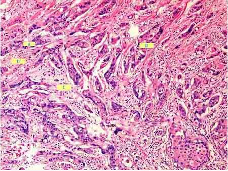 卵巢囊肿有什么症状(卵巢囊肿早期的症状）