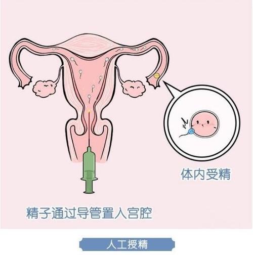 人工受精和试管婴儿的区别(了解人工受孕过程)