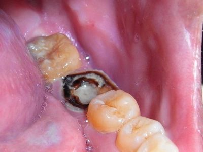 补牙多久可以怀孕(备孕前一定要补蛀牙吗）