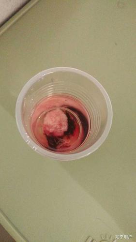 同房后两个月孕囊多大(孕囊多大mm时有卵黄囊)