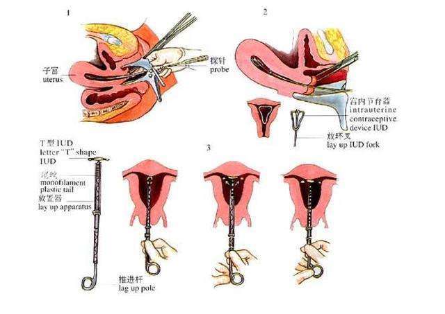 取环痛还是上环痛小手术真的就不痛吗？(上环13年取环痛吗）