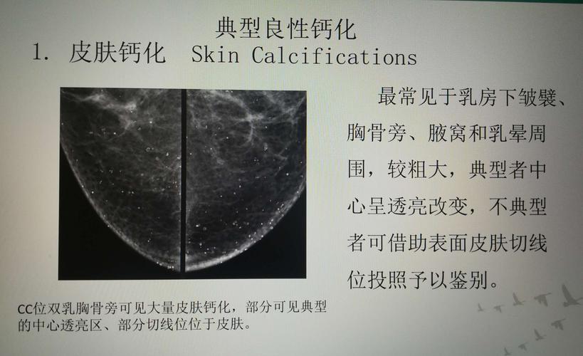 前列腺钙化灶是癌症吗前列腺钙化灶真的这么可怕吗？(前列腺内见钙化灶什么意思）