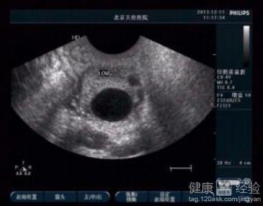 卵泡小排出后能如常怀孕吗(卵子排出后48小时还能受孕吗）