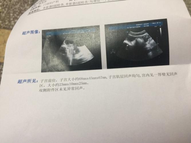 同房25天孕囊多大(同房23天孕囊多大）