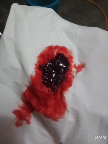 例假血块排出像猪肝正常吗(恶露排出猪肝状大块）