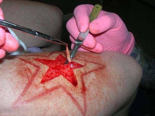 割皮手术多久可以同房(男生割皮治疗需要休息多久）