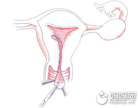 避孕套上有杀精剂吗(含杀精剂的避孕套有什么作用）