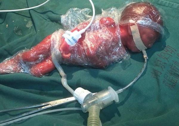 低出生体重儿和足月儿之间的差异(出生体重不足多少称为低出生体重儿）