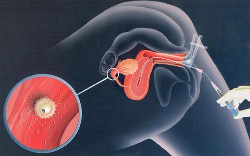 人工授精适合什么人群(什么样的人需要做人工授精)