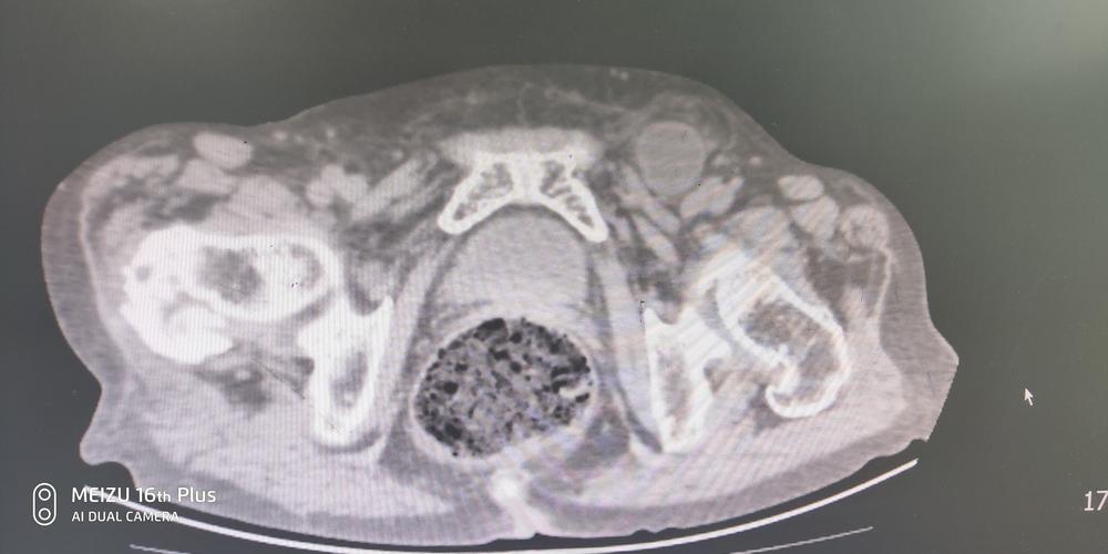 包茎嵌顿自己能好吗(能翻出来但嵌顿）