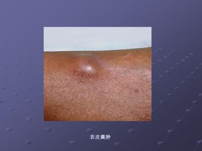 右侧附件囊肿要紧吗(附件囊肿60x48要不要紧）