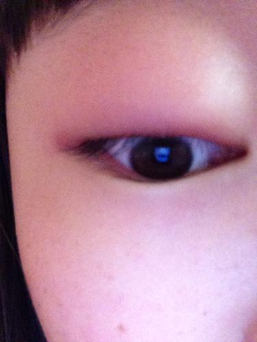 例假前眼睛水肿怎么办(来事会引起眼睛肿吗)