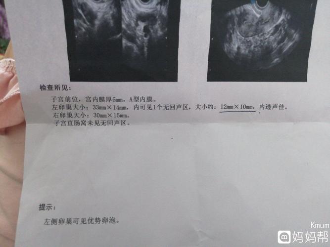 卵泡监测有用吗(为什么要做卵泡监测）