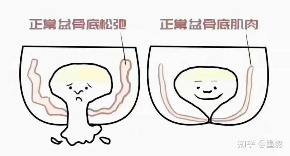 产后阴道壁膨出，还能生二孩吗？(二胎前壁膨出严重可以吗）