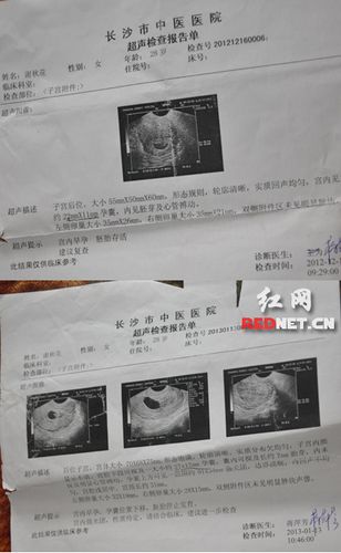 做怀孕检查b超要空腹吗(早孕b超检查需要空腹吗）