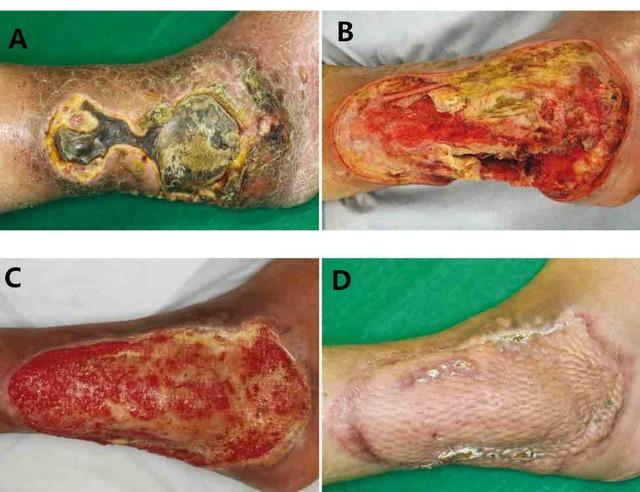 口腔溃疡可以吃泡椒凤爪吗(泡鸡爪怎么泡最好吃）