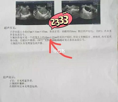 右侧附件囊肿是什么原因造成的(右侧附件囊肿怎么引起的）