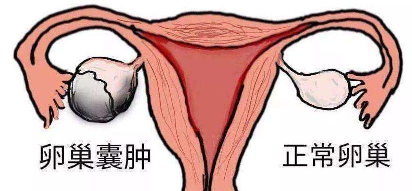 卵巢囊肿影响怀孕吗(卵巢囊肿5cm能怀孩子吗）