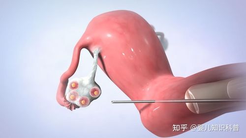 取卵时肚子有多疼?会流血吗?(取卵后肚子多久能变小)
