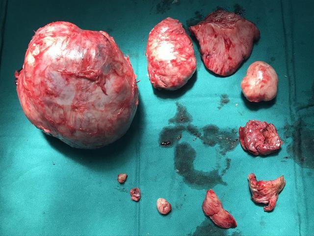 卵巢囊肿吃什么药消除(双侧卵巢多囊能怀上宝宝吗）