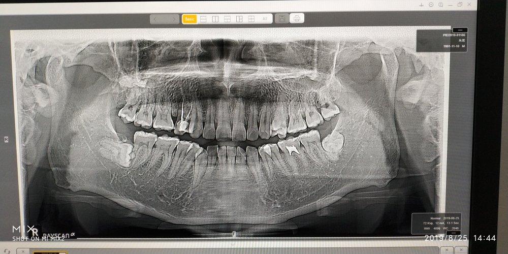 补牙拍片多久可以怀孕(补牙打了麻药多久可以怀孕）