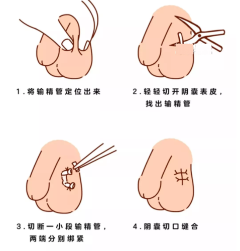 做节育男的做好吗(结扎是男的做还是女的）