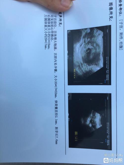 同房受孕50天孕囊多大(实际同房30天,孕囊多大）