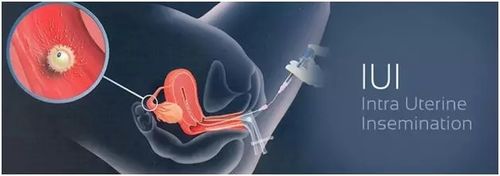 人工授精和人工受精的区别有哪些字面相似本质相差(人工授精后腹痛是成功）