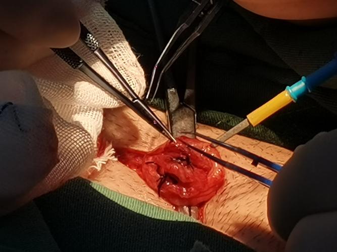 剖腹产结扎后会怀孕吗(剖宫产然后直接结扎有没有影响身体）