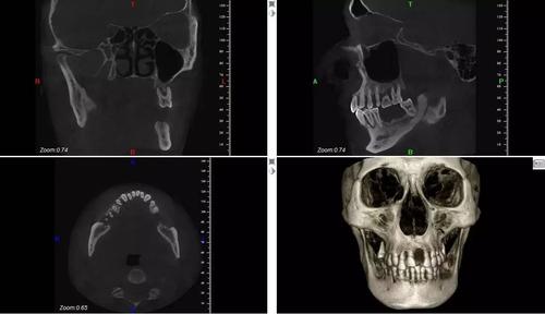 口腔ct多久可以怀孕(口腔ct备孕可以做吗)