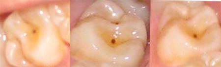 补牙多久可以怀孕(备孕前一定要补蛀牙吗）