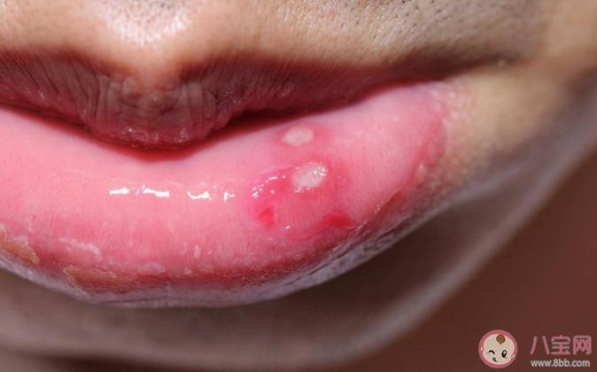 口腔溃疡可以喝奶茶吗(嘴总是溃疡怎么回事）