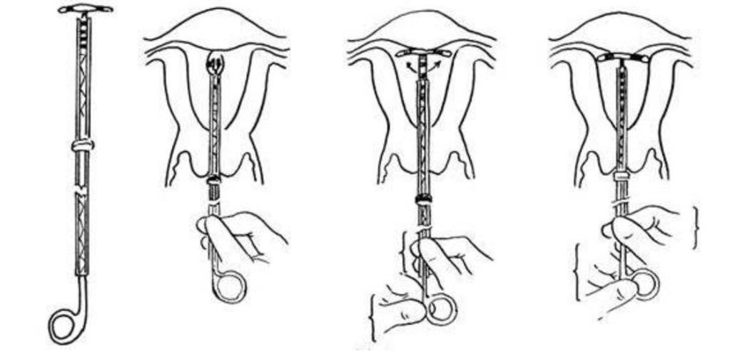 节育环为什么能避孕(夫妻长期避孕最好方法）