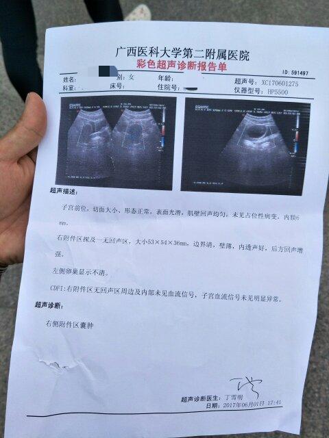 右侧附件囊肿要紧吗(附件囊肿60x48要不要紧）