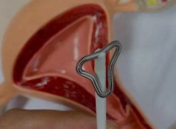 取环后可以碰凉水吗冷水真的会刺激子宫吗？(取环能碰坏别的地方吗）