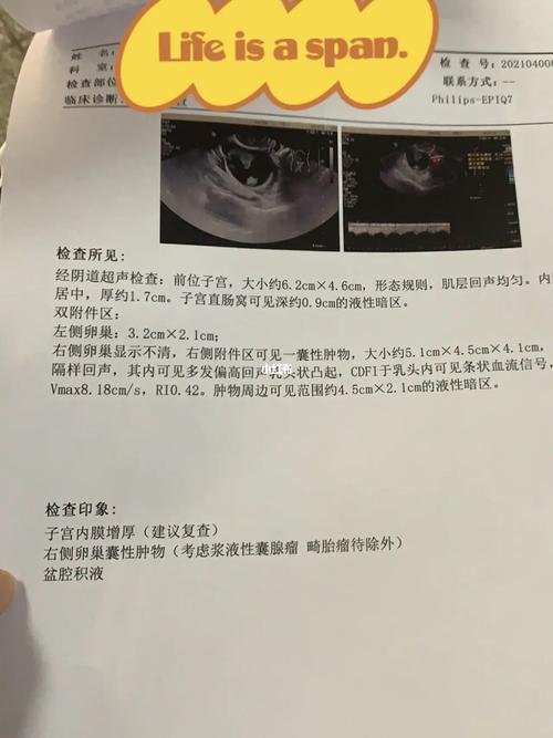 卵巢囊肿影响怀孕吗(卵巢囊肿5cm能怀孩子吗）