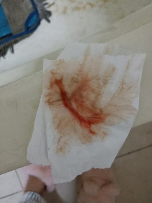 分泌物有血丝怎么回事(白带里有轻微血丝是怎么回事)