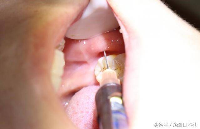 老公拔牙可以怀孕吗(拔牙打麻药当月怀孕了）