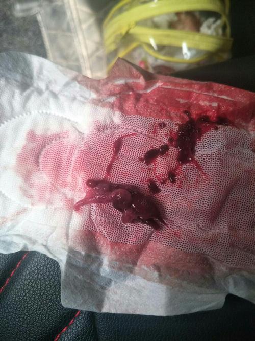 人流20天后同房一次会怀孕吗(打完胎一个多月没来姨妈是怎么回事)