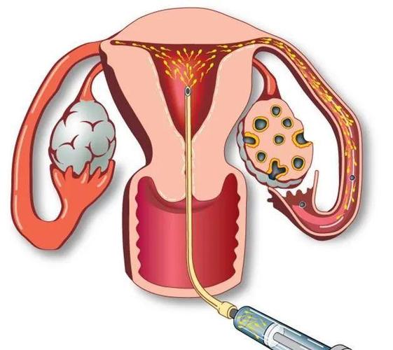 人工受孕需要取卵子吗(取卵子和精子人工能培育吗）