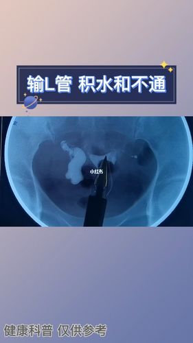 为什么会发生输卵管积水?怎样知道输卵管有没有积水?(输卵管积水常见吗)