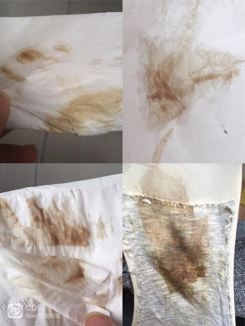 褐色的白带如何调理(黑褐色分泌物怎么回事没来月经）