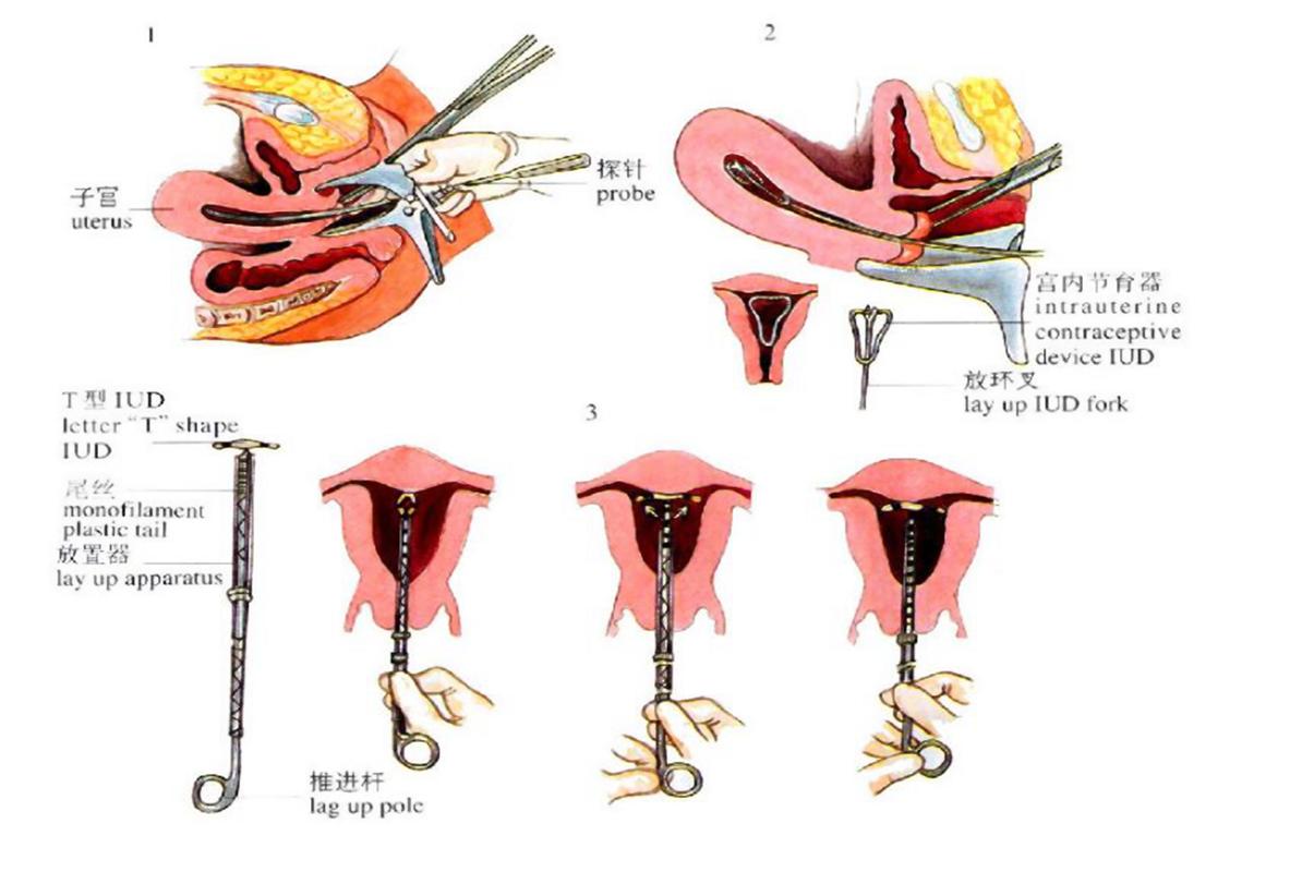 取环后会出血几天私处出血不要大意(取环后出血多是怎么回事）