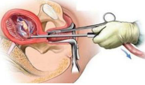人流十次多还会怀孕吗(做过十次人流还能再做吧）
