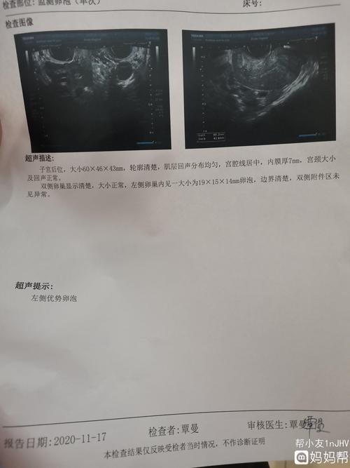 卵巢早衰可以做试管婴儿怀孕吗(左侧卵泡怀孕必生男孩）