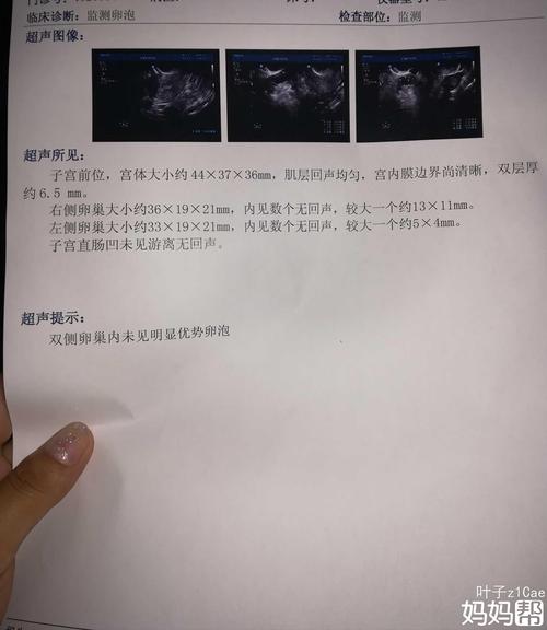 卵泡1(只有一个优势卵泡正常吗）