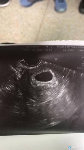 同房后两个月孕囊多大(孕囊多大mm时有卵黄囊)