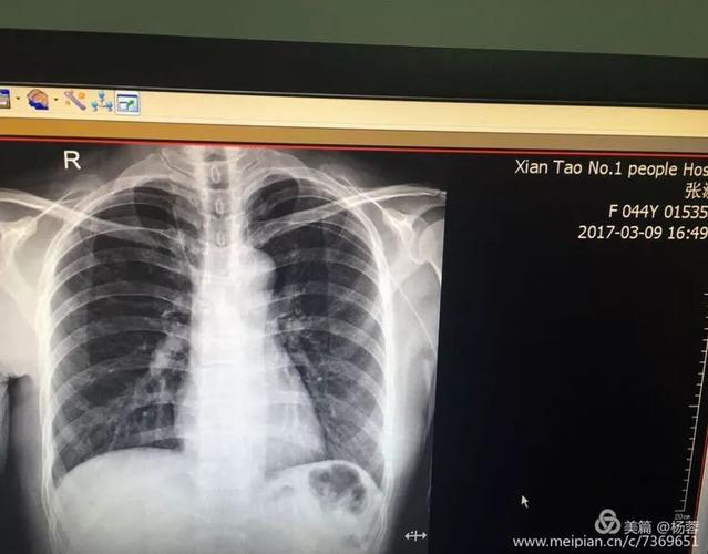 卵巢畸形瘤忌讳什么(畸胎瘤怕什么)