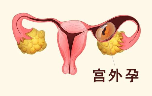 什么样的人容易患上宫外孕(什么人容易宫外孕)