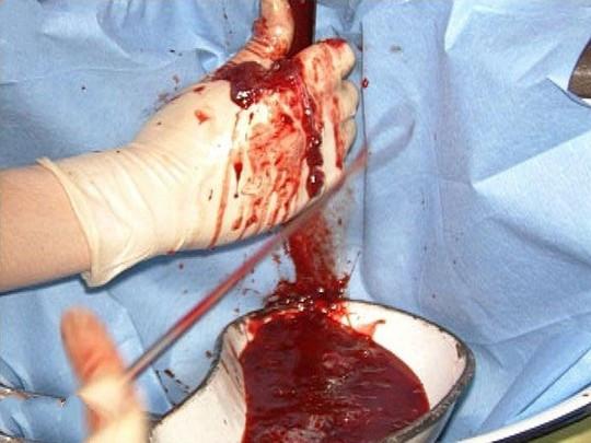 人工流产后多久能上班人流后能马上上班吗?(人流是怎么做的过程)